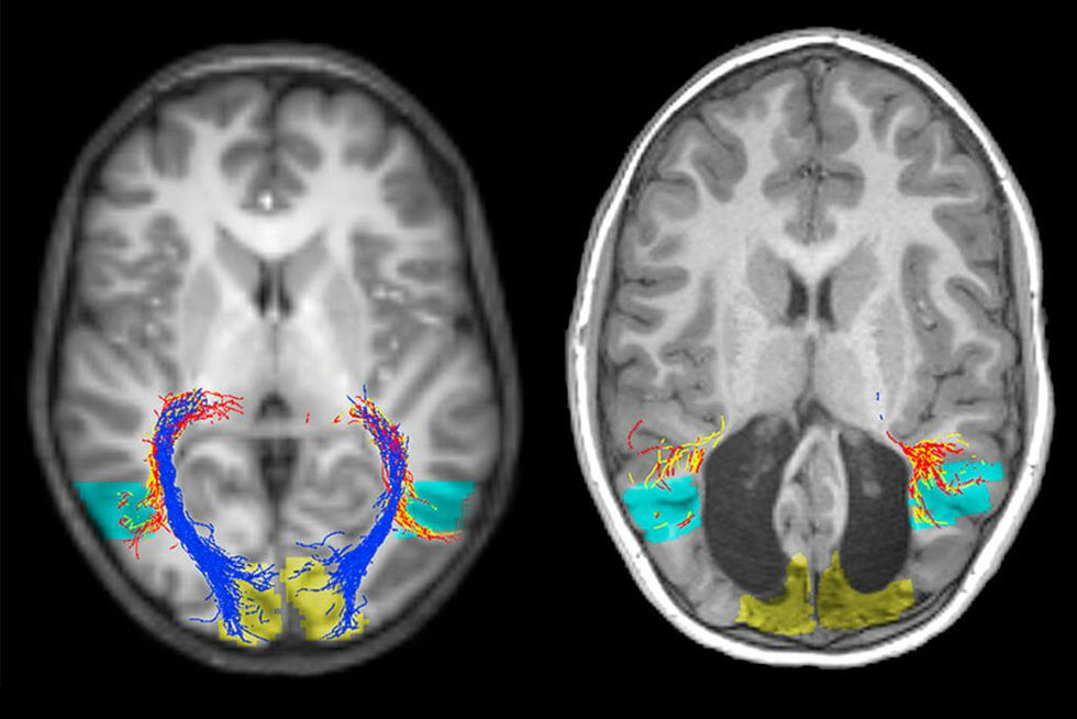 A normal brain (left) and the boy missing a visual cortex (right)
