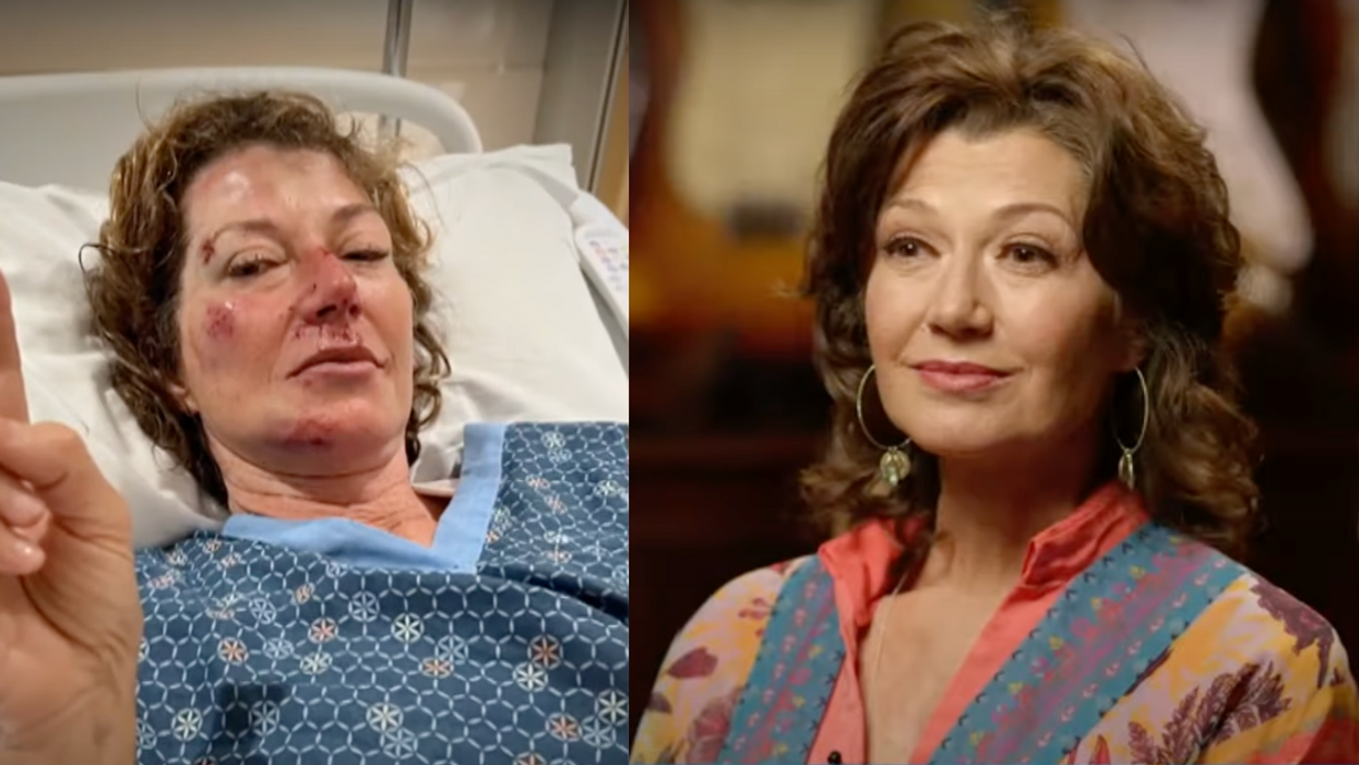 A split image with singer Amy Grant lying in a hospital bed with bruises on her face holding up a peace sign on the left and Amy Grant sitting comfortably on a TV set for an interview on the right, visible injuries completely healed