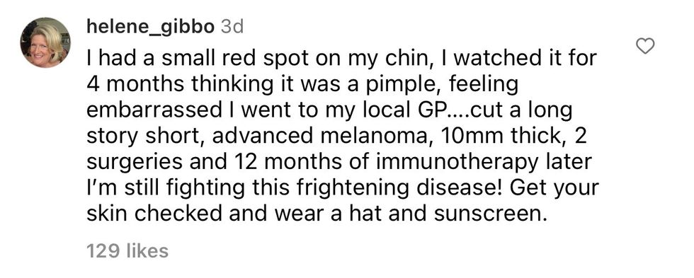 Comment from Instagram user helene_gibbo "I had a small red spot on my chin, I watched it for 4 months thinking it was a pimple, feeling embarrassed I wen to my local GP .... cut a long story short, advanced melanoma, 10mm thick, 2 surgeries and 12 months of immunotherapy later I'm still fighting this frightening disease! Get your skin checked and wear a hat and sunscreen."