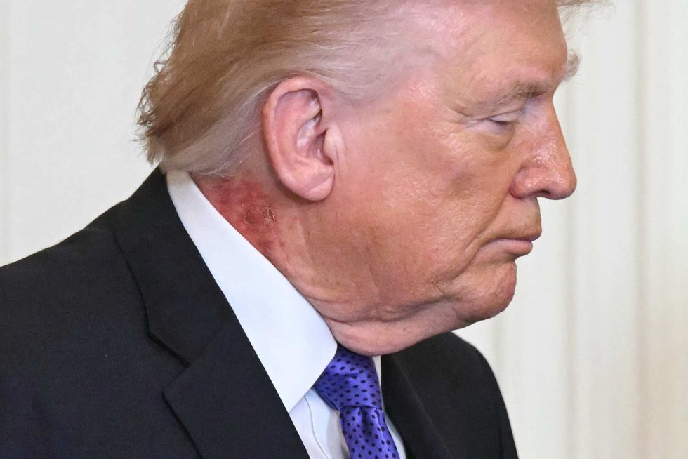 Donald Trump's rash is seen on the back of his neck