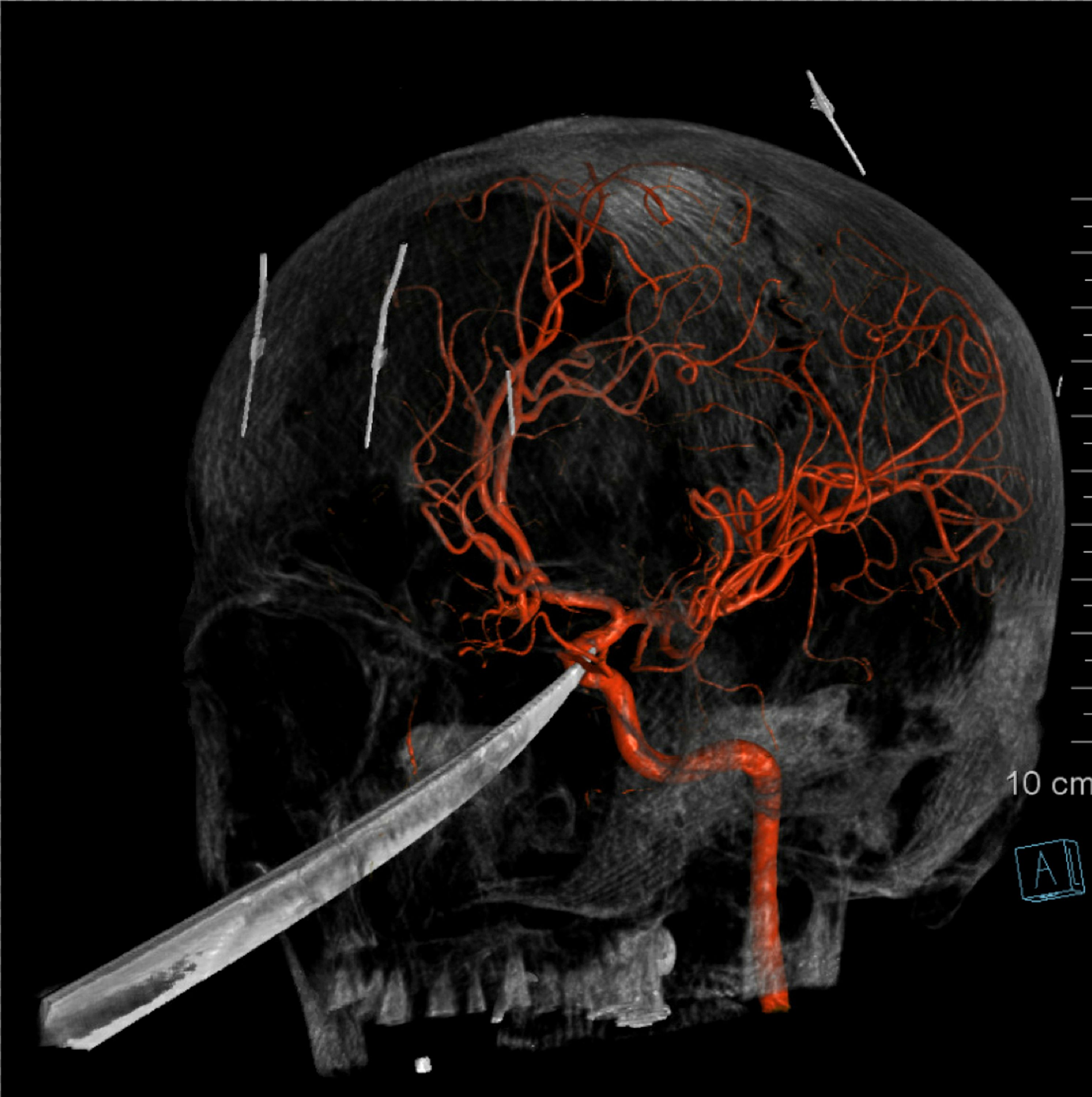 3D computer graphic model made from X-Ray imagery by The University of Kansas Health System shows how a tip of the knife stopped right on and was pressed against the carotid artery