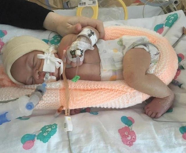 Felicity had to be resuscitated when she was born