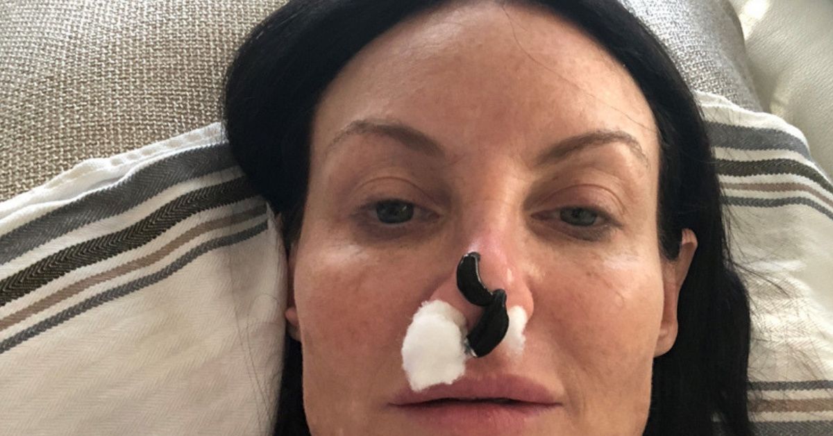 Woman Saves Nose After Botched Plastic Surgery By Using Blood-Sucking Leeches