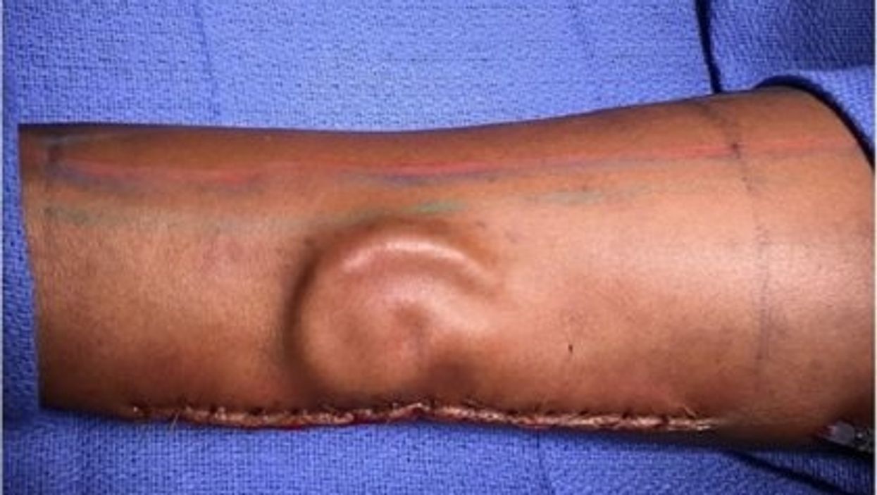 This Ear Transplant Was Made From Rib Cartilage And Grown In The Patient's Arm. You Know, Normal Stuff.