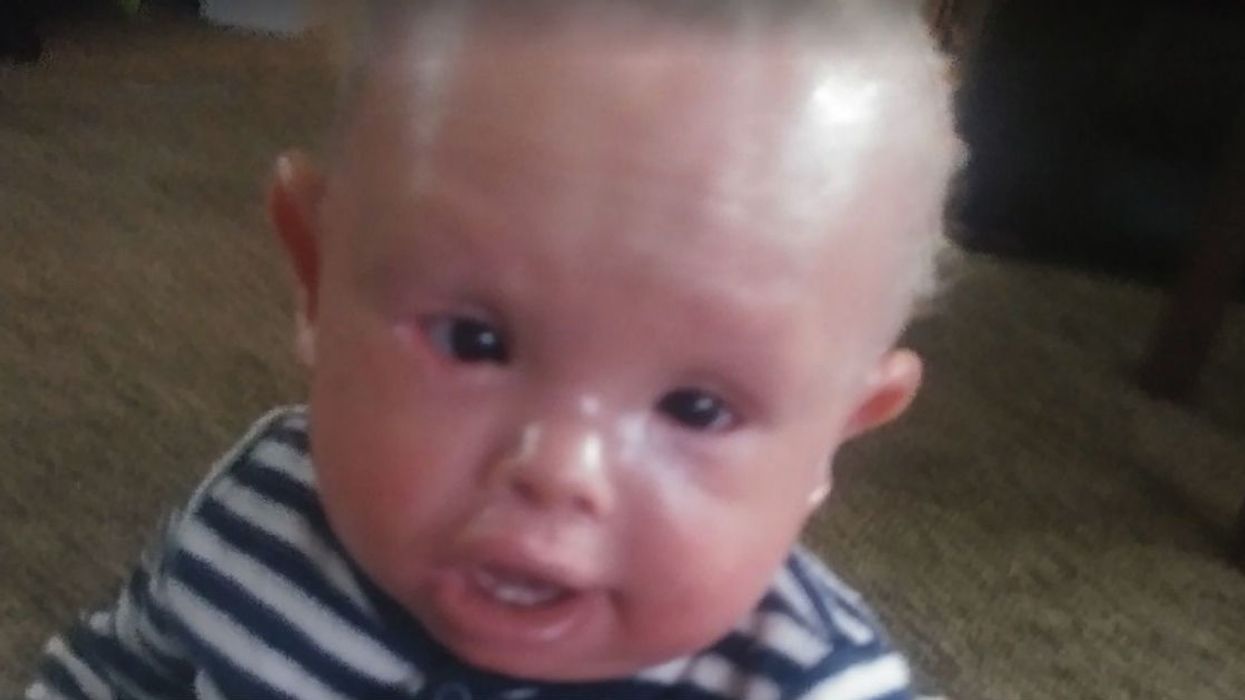 This 1-Year-Old Baby Has To Take Baths With Bleach To Survive Rare Skin Disorder