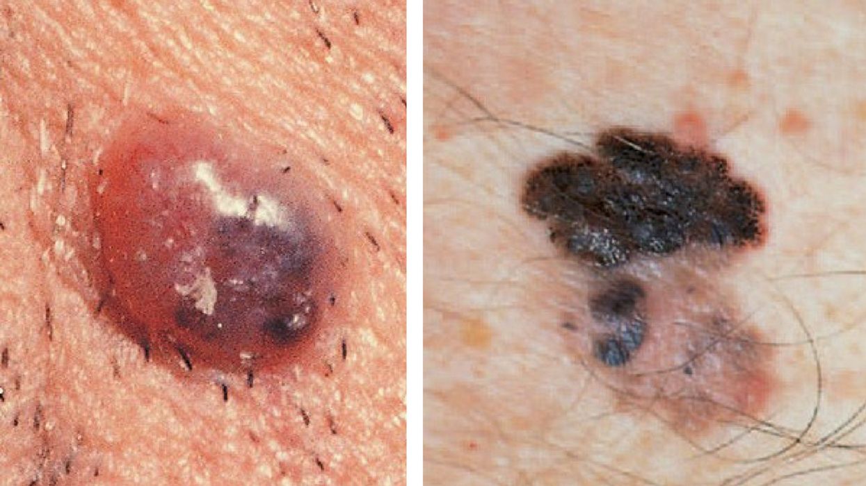 How To Spot The Most Common Forms Of Skin Cancer