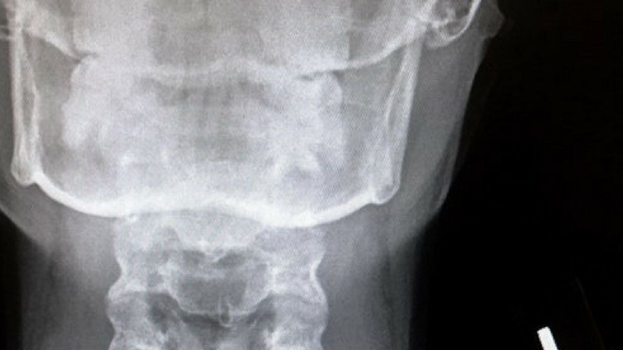 Teen Dubbed 'Batgirl' After Swallowing Earring That Made Its Way Into Her Inhaler