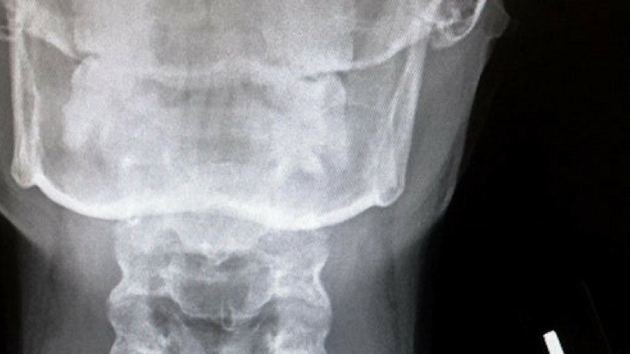 Teen Dubbed 'Batgirl' After Swallowing Earring That Made Its Way Into Her Inhaler