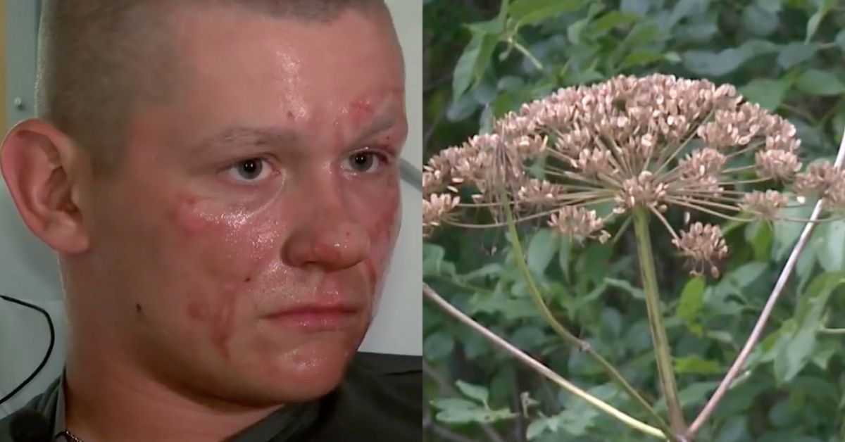 After Run-In With 'Plant From Hell,' Virginia Teen Might Not Be Able To Step Foot In The Sun For 6 Months 😮