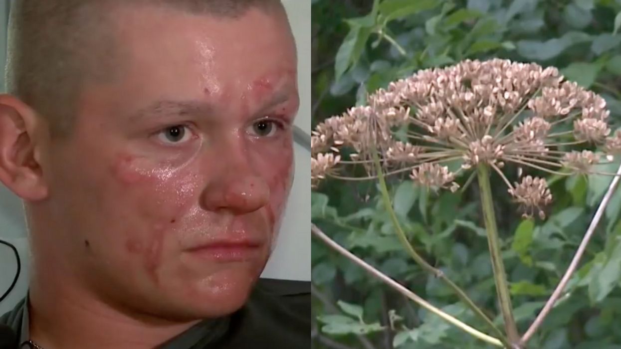 After Run-In With 'Plant From Hell,' Virginia Teen Might Not Be Able To Step Foot In The Sun For 6 Months 😮