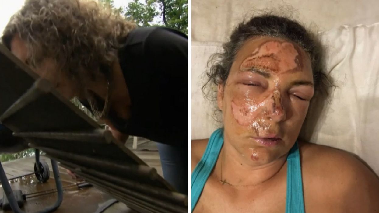 Husband's Quick Thinking Saved Wife's Face After She Fell Onto Hot Grill