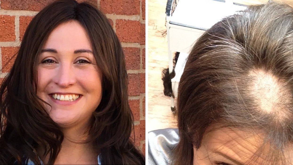 After Car Crash, Woman Starts Compulsively Yanking Out Hair In Fistfuls