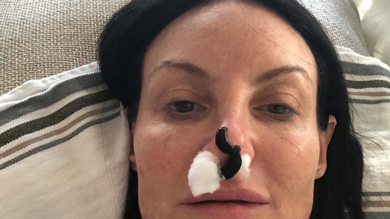 Woman Saves Nose After Botched Plastic Surgery By Using Blood-Sucking Leeches