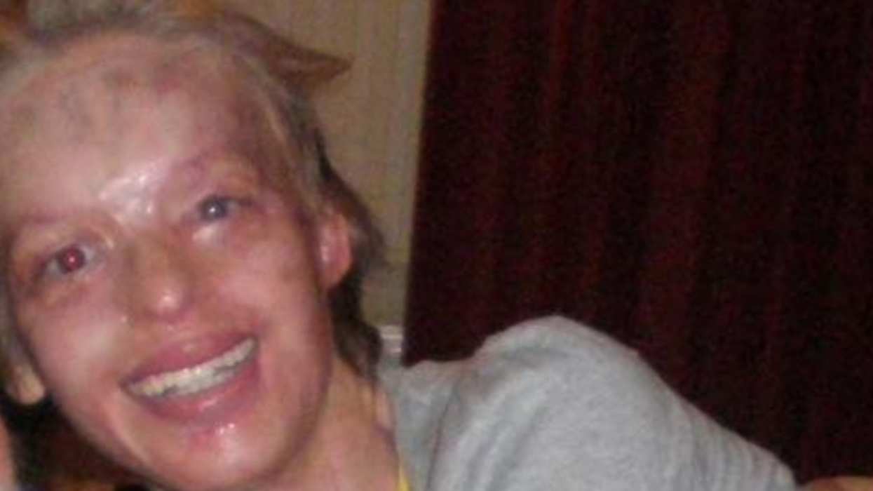 Acid Attack Survivor's 10-Year Challenge Is Inspiring People All Over The Internet ❤️