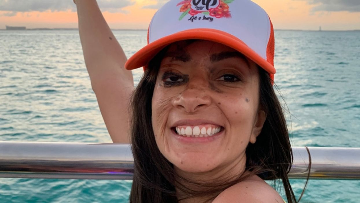 Woman Dubbed 'Monster' As A Child For Birthmark Covering Nearly Half Her Face Has Powerful Message For Others