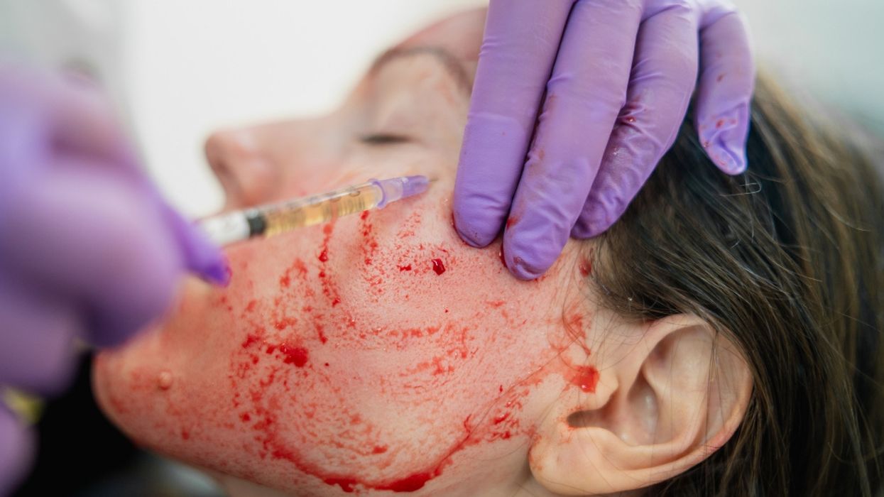 Officials Issue Warning After 'Vampire' Facials From New Mexico Spa Result In HIV Diagnosis For Two Clients
