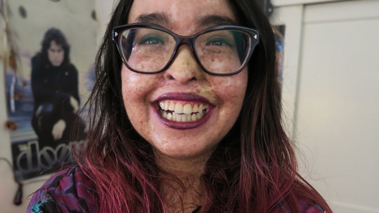 Blogger With Incredibly Rare Sunlight Allergy Forced To Live Like A Real-Life Vampire