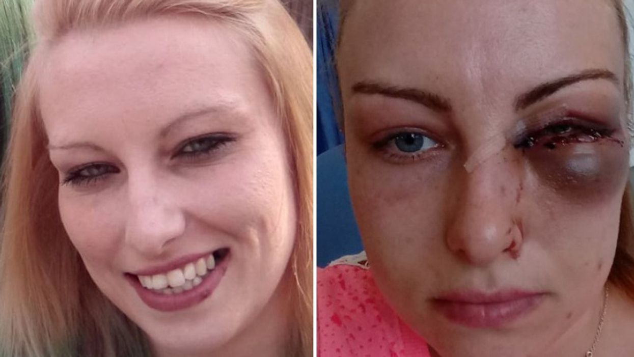 Woman Whose Vision Was Damaged After Her Jealous Boyfriend Fractured Her Eye Socket Has A Powerful Message For Others