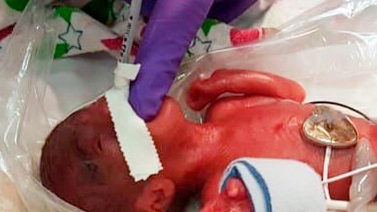 Girl Believed To Be The Tiniest Baby Ever To Survive Only Weighed As Much As An Apple At Birth