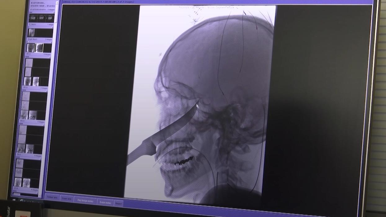 Boy Miraculously Survives Being Impaled In The Face By A 10-Inch Knife