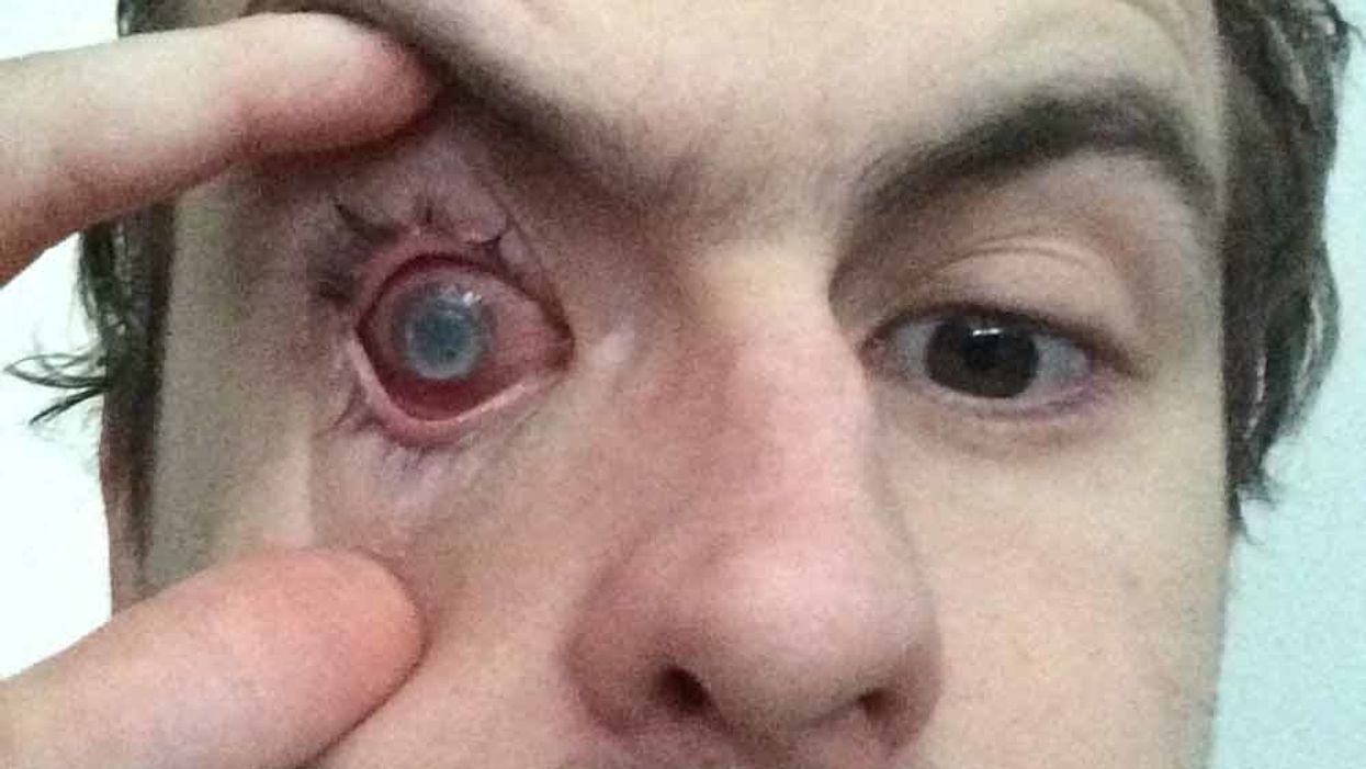 Man Has A Warning For Others After Wearing A Contact Lens In The Shower Leaves Him Blind