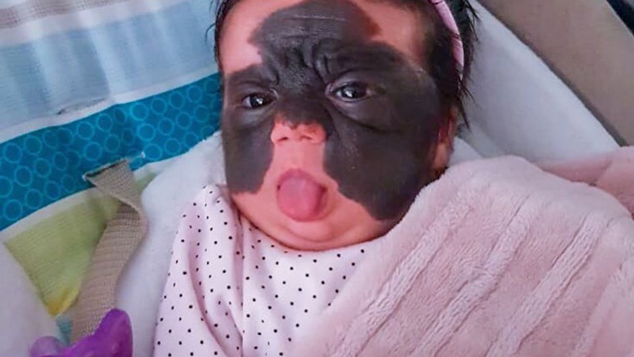 Mother Of Girl With 'Batman' Birthmark Covering Her Face Has A Message For Strangers Who Call Her Baby A 'Monster'
