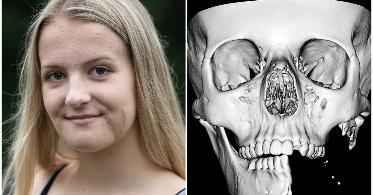 Surgeon Rebuilds Teen's Face After Horseback Riding Accident Shatters Her Jaw