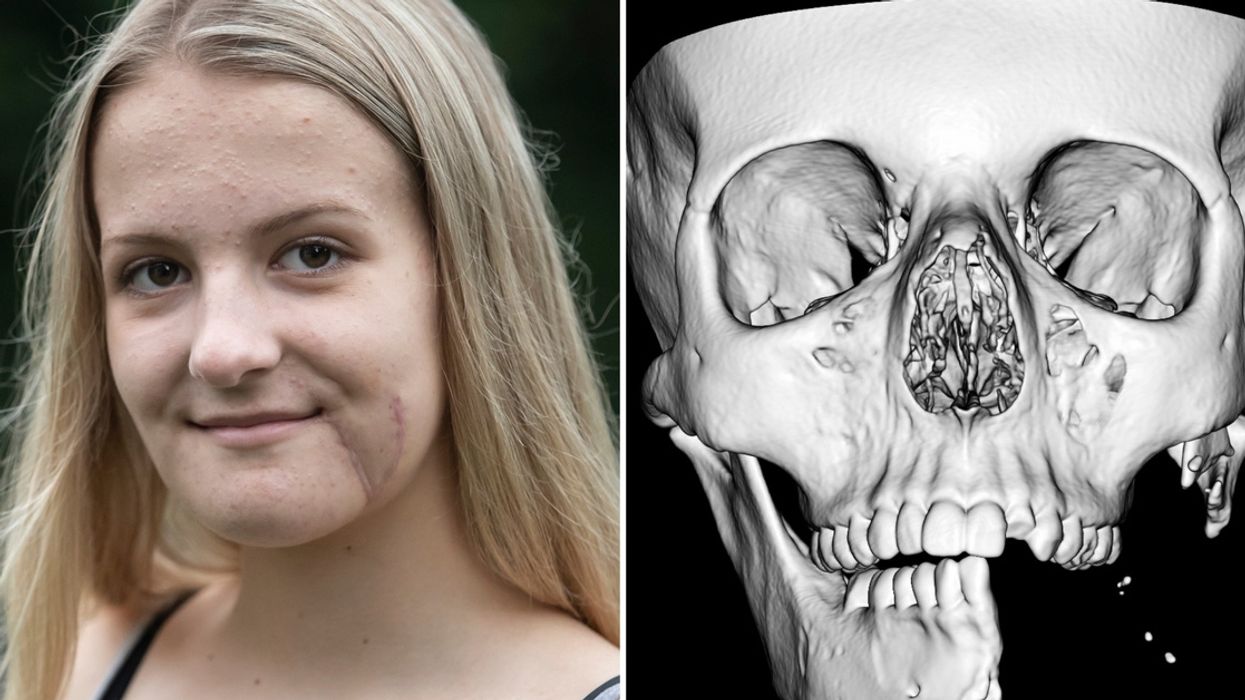 Surgeon Rebuilds Teen's Face After Horseback Riding Accident Shatters Her Jaw