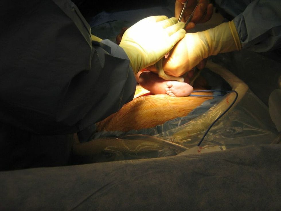 Not Your Mother’s Pelvis: Could C-Sections Be Changing the Course of Evolution?