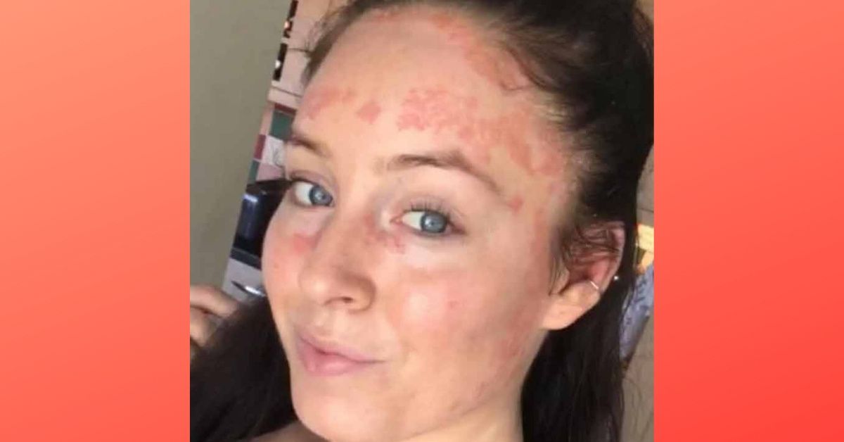 Woman Whose Psoriasis Is So Severe It's Even Inside Her Eyelids Learns To Embrace Her Skin Thanks To Instagram
