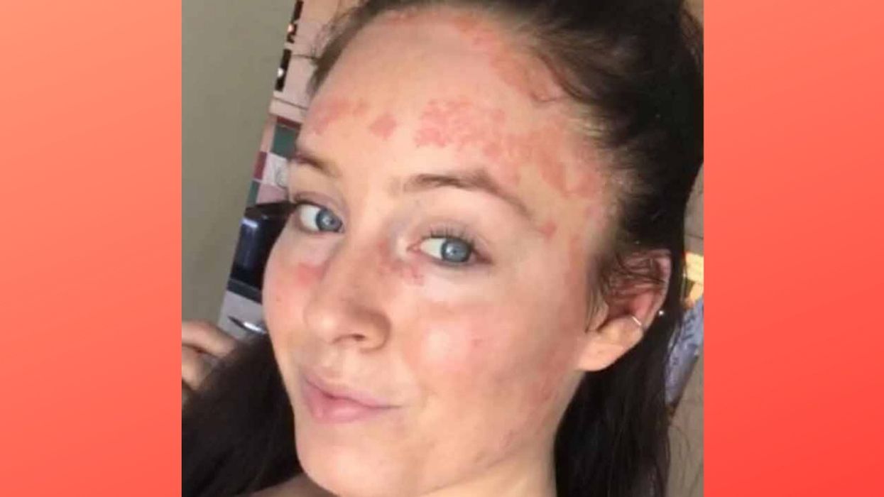 Woman Whose Psoriasis Is So Severe It's Even Inside Her Eyelids Learns To Embrace Her Skin Thanks To Instagram