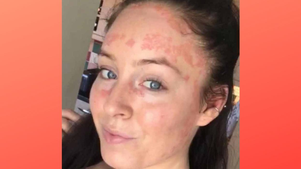 Woman Whose Psoriasis Is So Severe It's Even Inside Her Eyelids Learns To Embrace Her Skin Thanks To Instagram