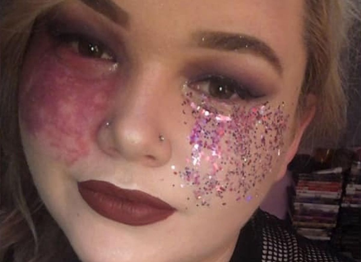 Self-Styled 'Birthmark Queen' Opts Out Of Laser Surgery, Urges Others To Love Their Imperfections