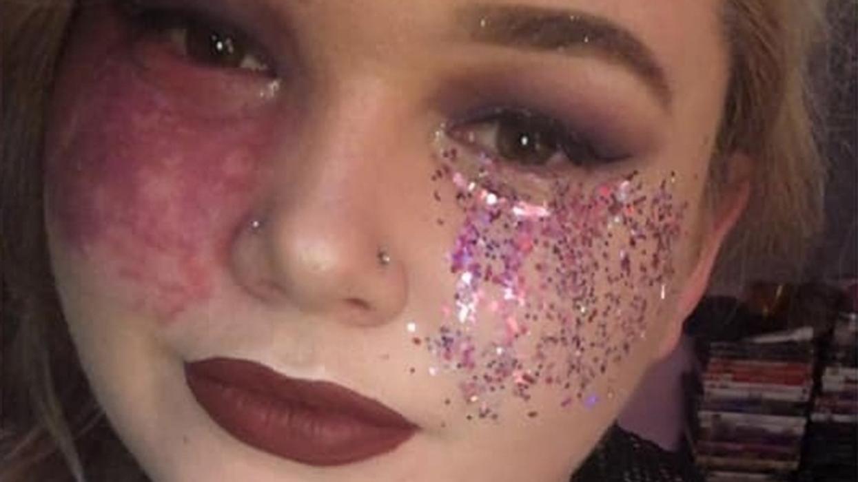 Self-Styled 'Birthmark Queen' Opts Out Of Laser Surgery, Urges Others To Love Their Imperfections