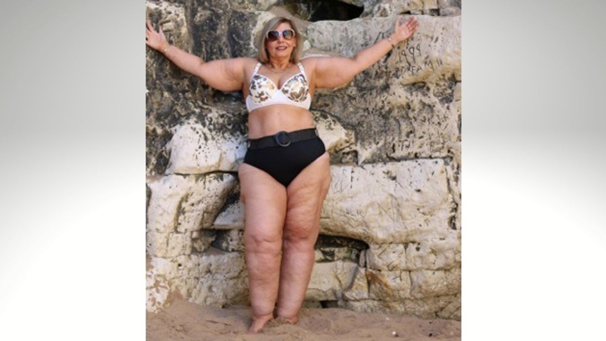 Woman With Rare Condition Told By Strangers That She Would 'Look Better As An Amputee'