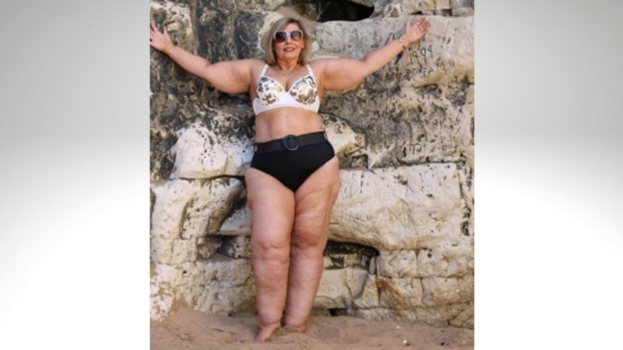 Woman With Rare Condition Told By Strangers That She Would 'Look Better As An Amputee'