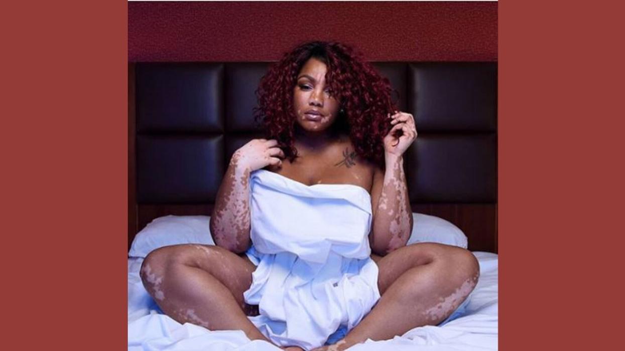 Childhood Beauty Pageant Star Devastated By Vitiligo Diagnosis Finds Success As A Model