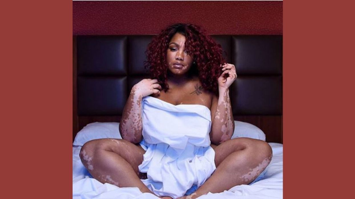 Childhood Beauty Pageant Star Devastated By Vitiligo Diagnosis Finds Success As A Model