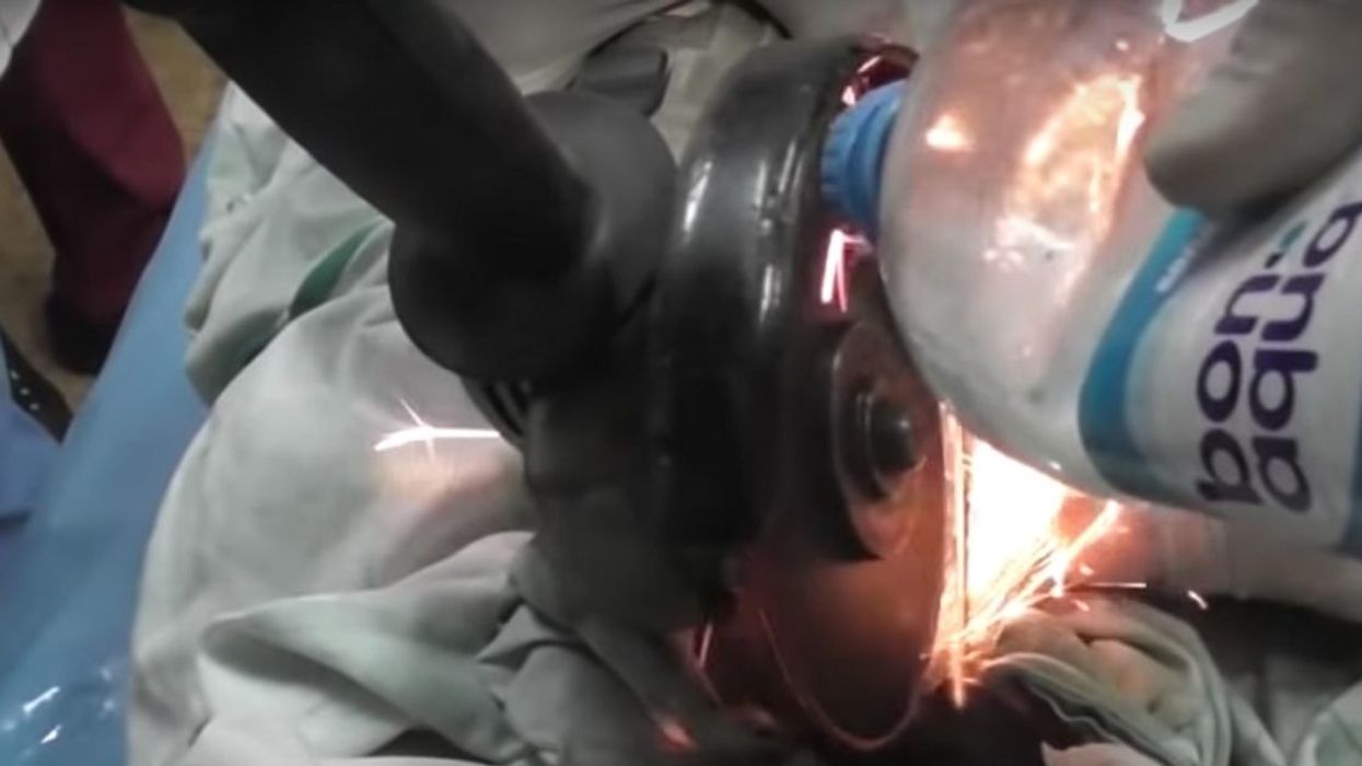 Man Woke Up To Find His Wife Put A Metal 'Chastity Nut' Around His Member, And It Had To Be Removed With A Saw