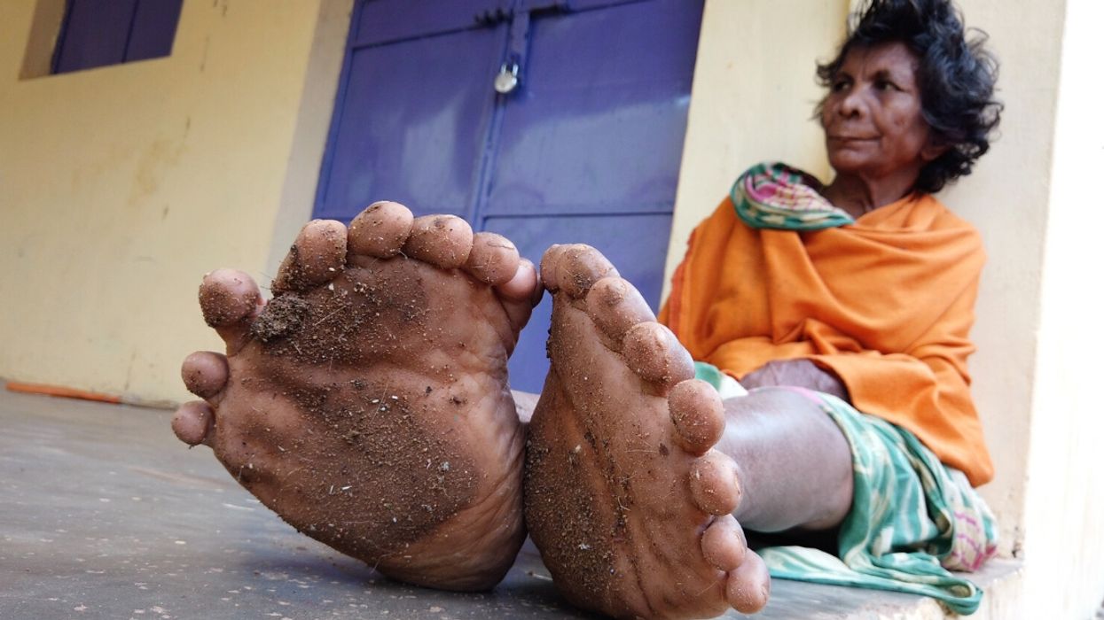 Woman With Record-Breaking 31 Fingers And Toes Says She's Been Branded A 'Witch' By Neighbors