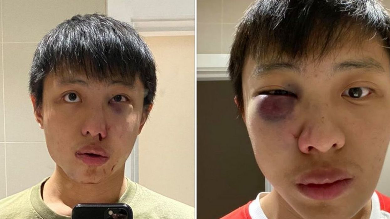 Asian Student Says A Group Of Men Assaulted Him And Told Him 'I Don’t Want Your Coronavirus In My Country'