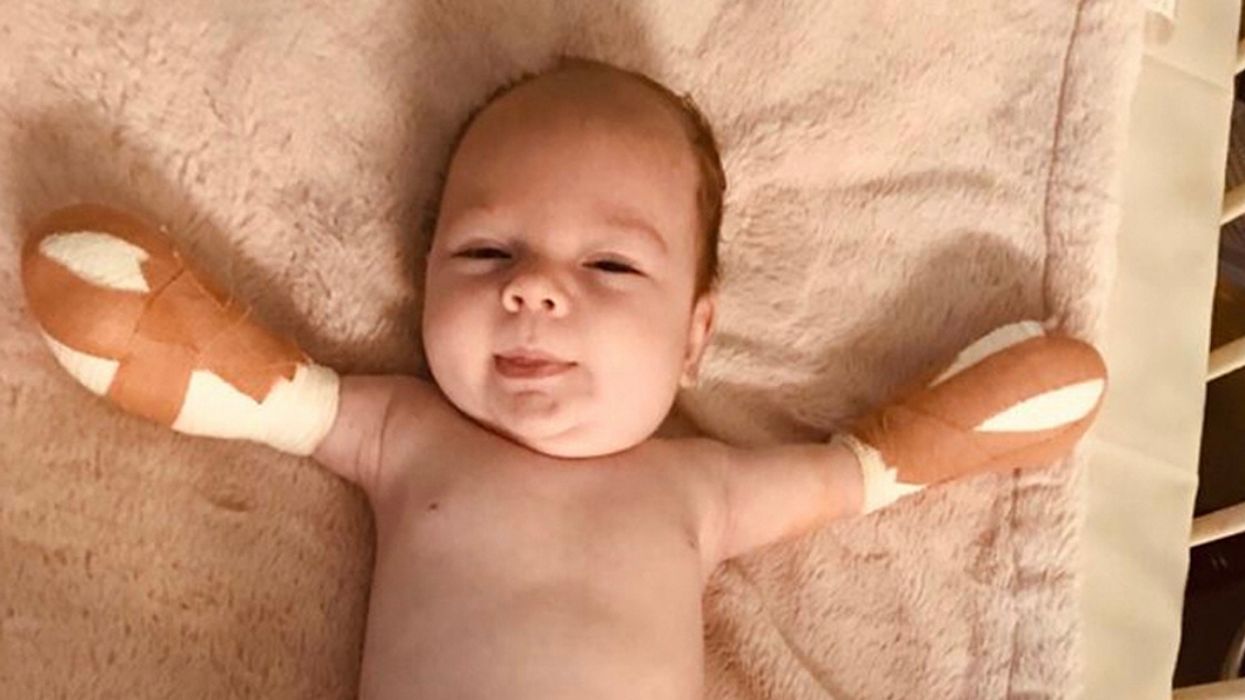 Baby Who Had A Stroke While In The Womb And Six Operations To Remove Her Limbs Still Has 'Biggest, Brightest Smile' Through It All