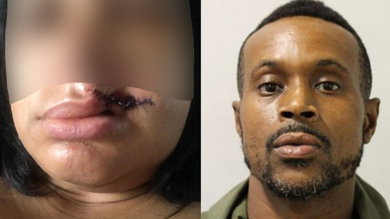 Mom Who Had Part Of Her Lip Bitten Off By A Stranger At A Carnival Is Now Too Scared To Go Out Alone