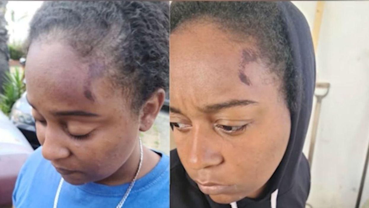 California Woman Sues After Cops Leave Her With Permanent Scars While She Filmed Arrest Happening In Her Yard