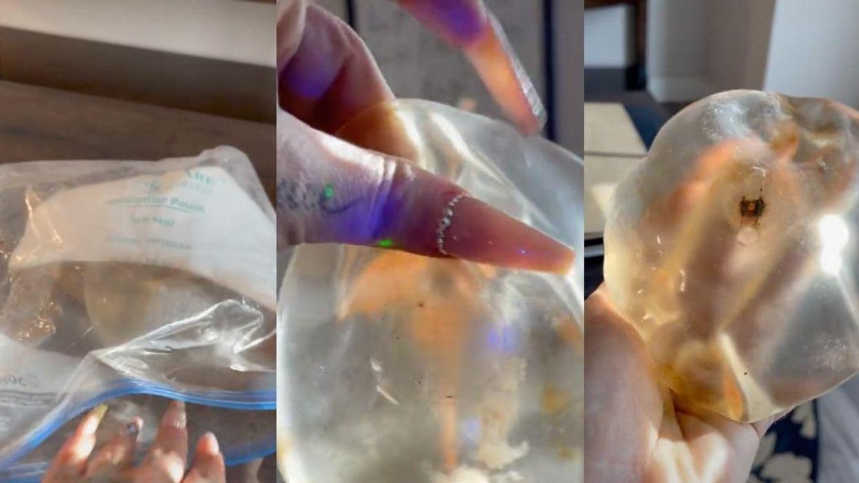 TikToker Who Got Her Breast Implants Removed Horrified To Realize They're Full Of Mold
