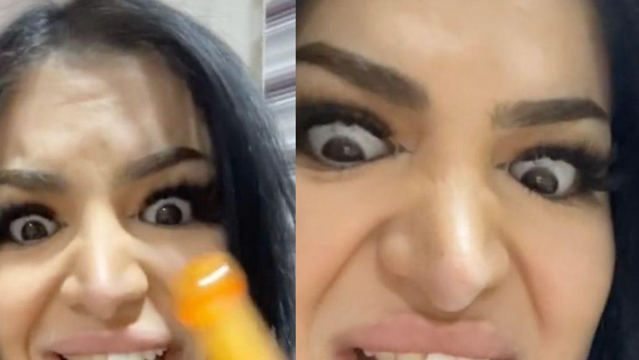 Woman Warns TikTok Not To Get Veneers Done Abroad 'On A Whim' After Nightmare Experience