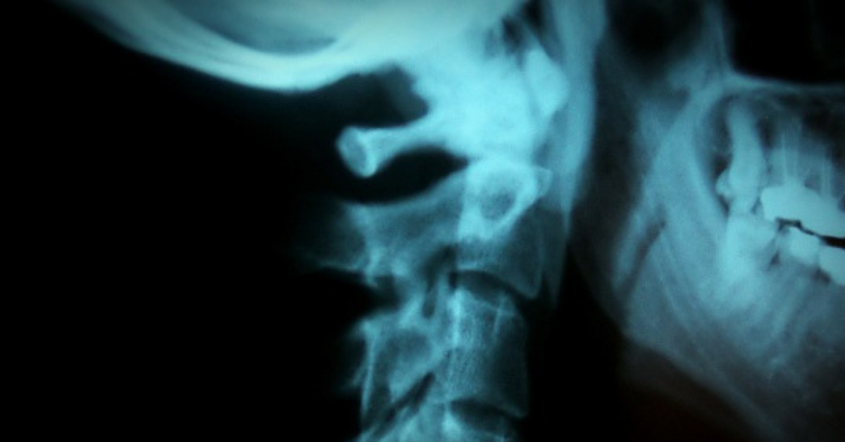 Man Who Was Warned By Wife About 'Cracking' His Neck Regularly Suffers Stroke From The Habit