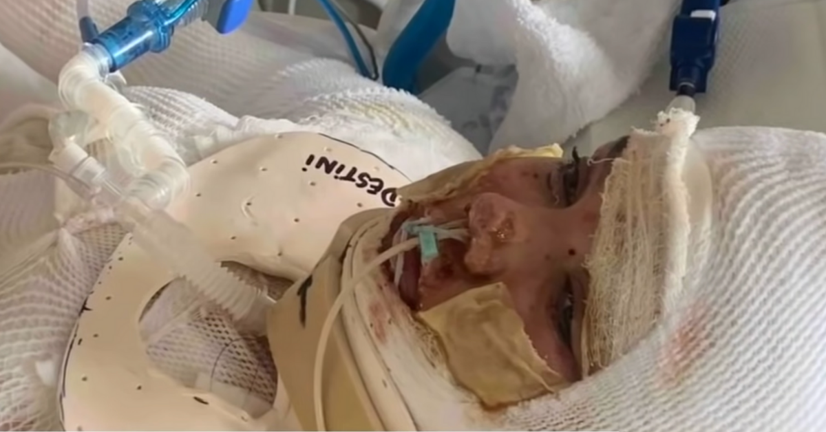 13-Year-Old Girl Permanently Disfigured By 3rd-Degree Burns After Trying To Copy Viral TikTok Trend