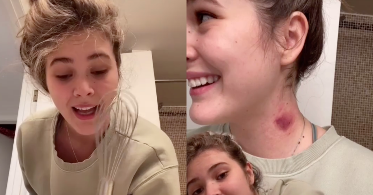 Teen Goes Viral For Whisk Hack For Getting Rid Of Hickeys VIDEO