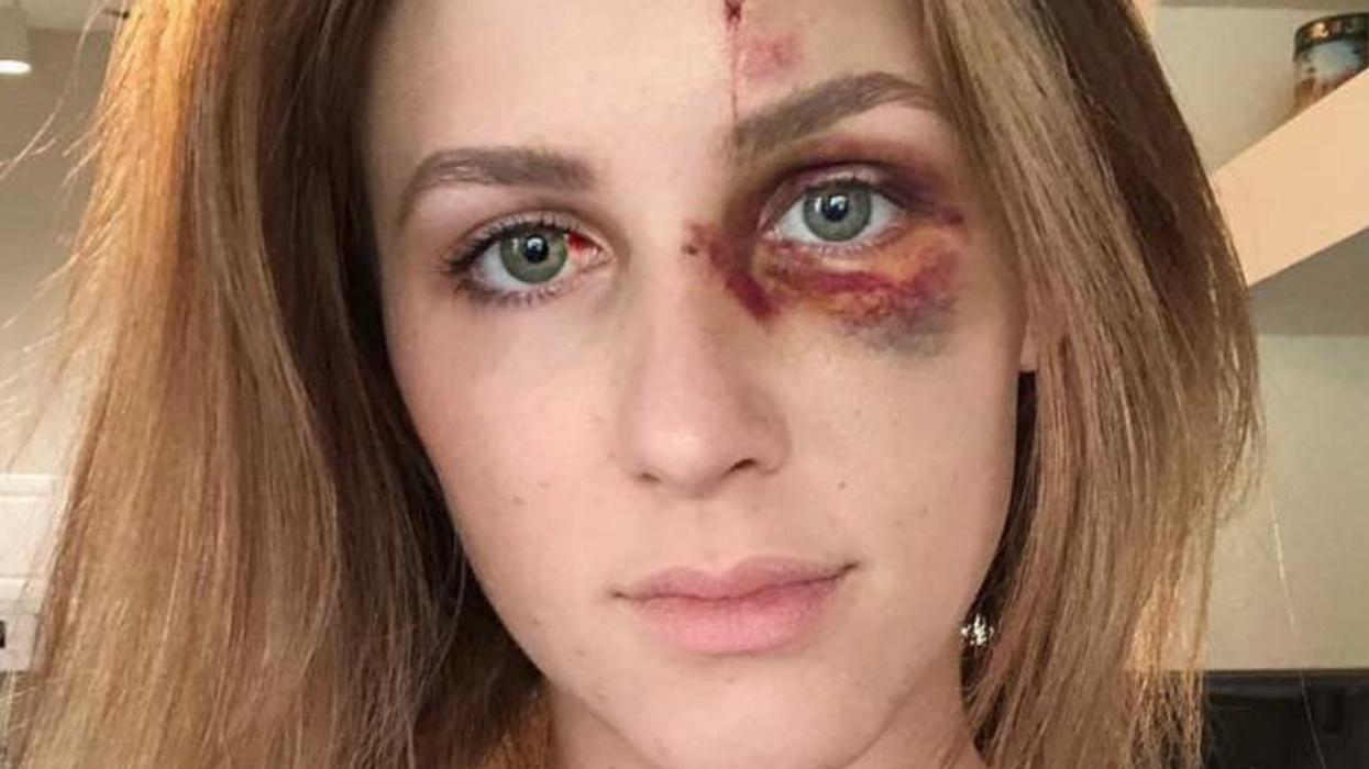 Woman's Message About Domestic Abuse Goes Viral When She Posts Pictures Of Her Assault On Instagram